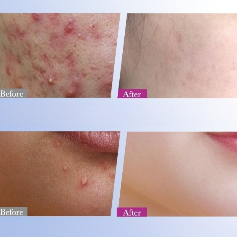 Parche colorido para acné de e - Skincare Qv reseña y precio